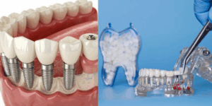 Dental Implants and Dental Bridges