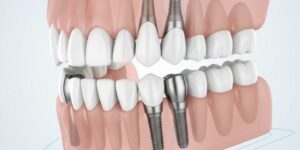 all-on-x dental implants benefits