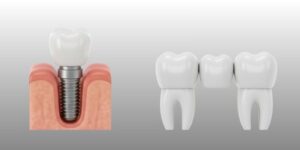 dental implants vs bridges