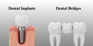 dental implants vs bridges