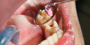 Comparing Root Canal vs Tooth Extraction