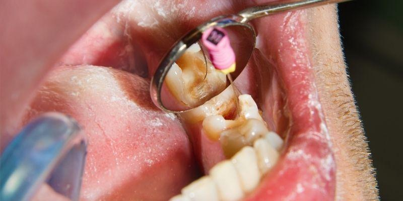 Comparing Root Canal vs Tooth Extraction
