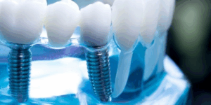 affordable dental implants