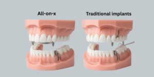 all-on-x vs traditional implants