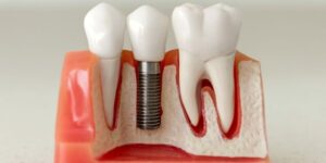 how long do dental implants last