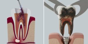root canal vs tooth extraction