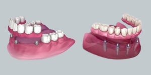 snap in dentures vs permanent dentures