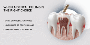 When a Dental Filling Is the Right Choice