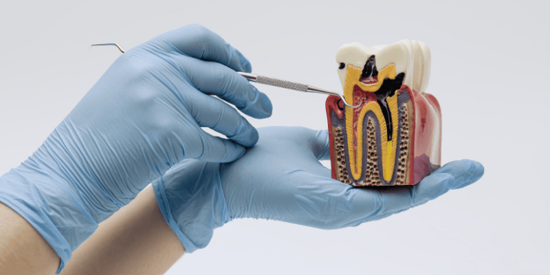 root canal recovery problems