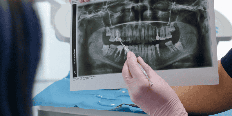 full mouth dental implants bone grafting