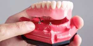snap in dentures vs fixed implant bridge
