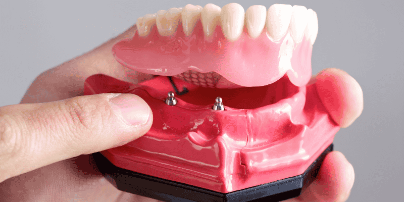 snap in dentures vs fixed implant bridge
