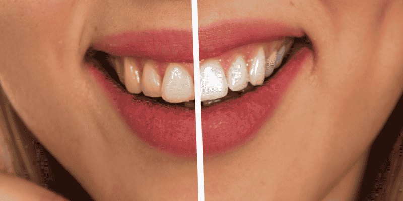 Two-Tone Smiles The Risk of Color Mismatch