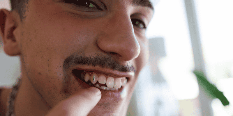 diamond teeth procedure