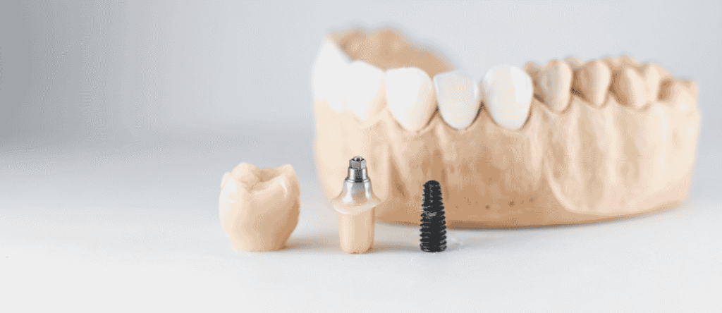 dental implants after years of wearing dentures