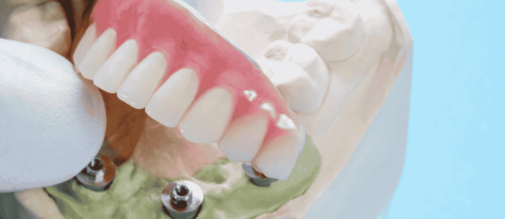 palateless snap on dentures