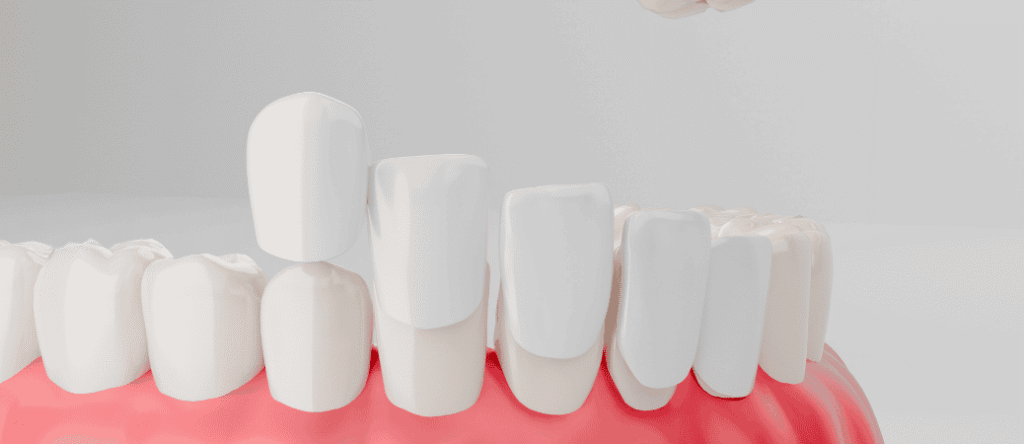 porcelain veneer candidacy in Wilmington, NC