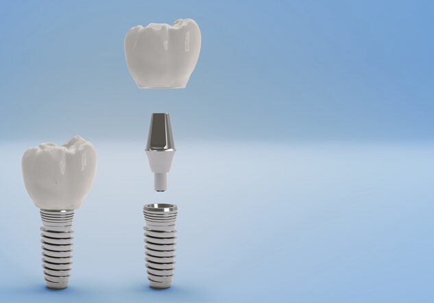 Dental Implants